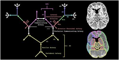 Spatial CT perfusion data helpful in automatically locating vessel occlusions for acute ischemic stroke patients